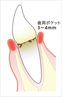 軽度歯周炎