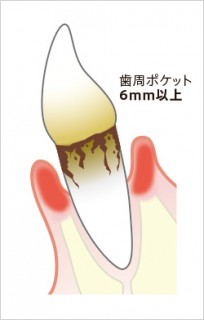 重度歯周炎