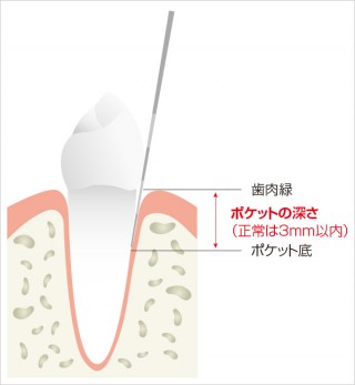 歯周病の検査